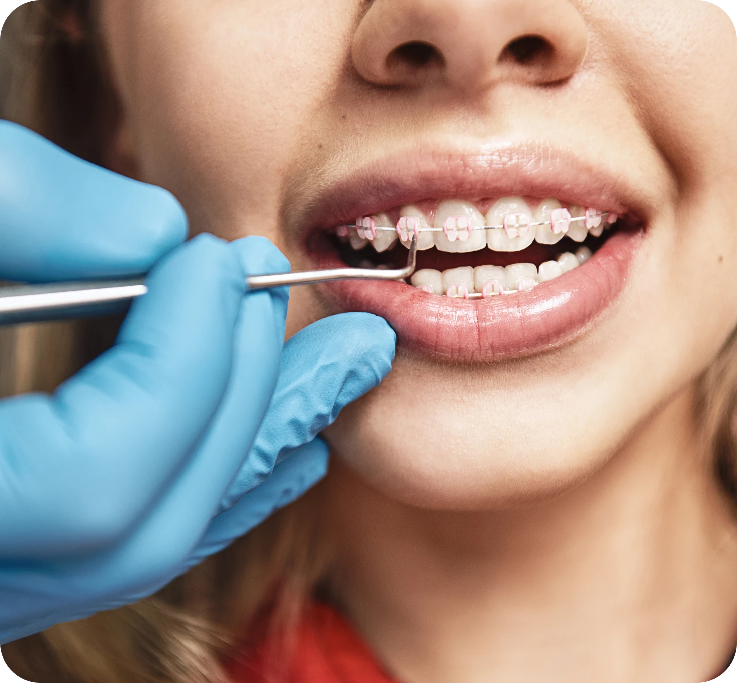 Appareil dentaire avec brackets transparents