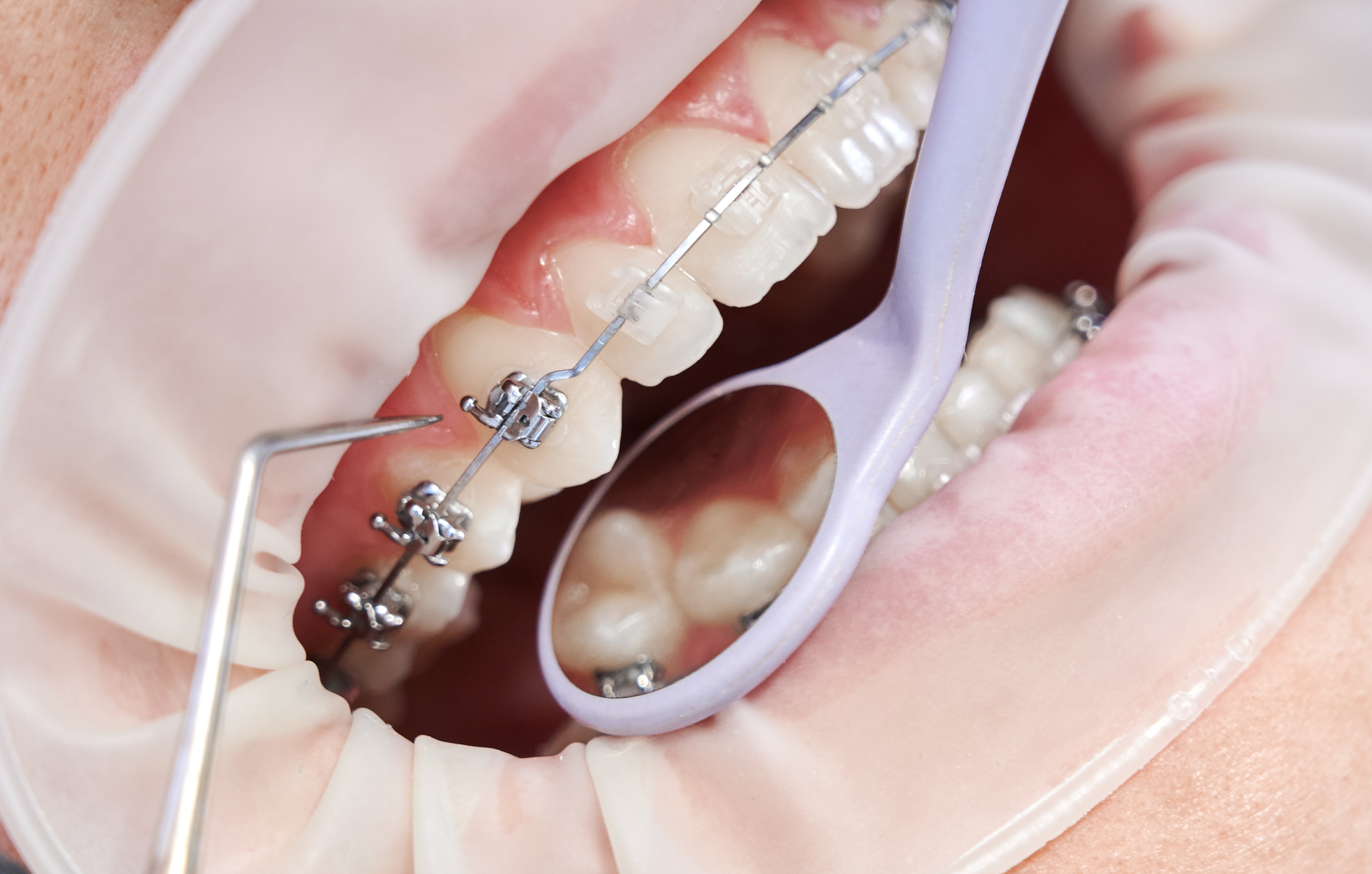 Appareil orthodontique avec bagues dentaires et fil métallique