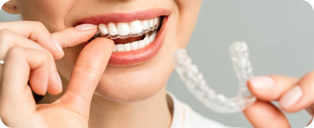 Invisalign braces near Monaco